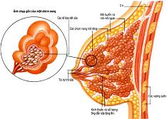 Các loại u vú lành tính thường gặp và cách điều trị
